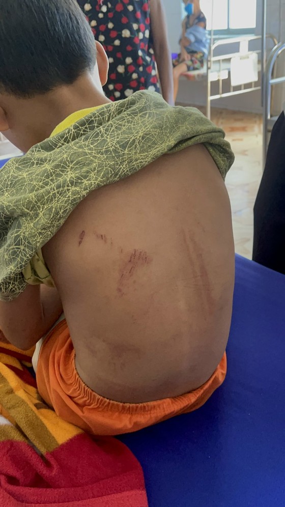 Quảng Bình: Phẫn nộ bé trai lớp 3 bị cha dùng xăng và rơm đốt cháy hai chân-2