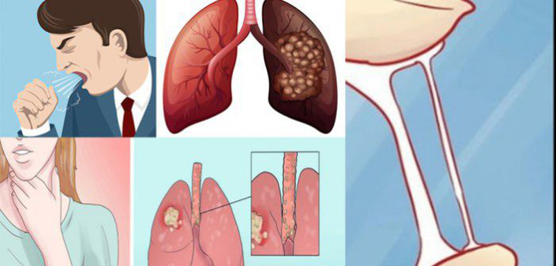 Biểu hiện sớm ung thư phổi ở giai đoạn đầu-1