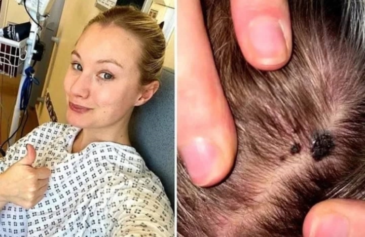 Cô gái 29 tuổi phát hiện ung thư từ vết lạ trên đầu-1