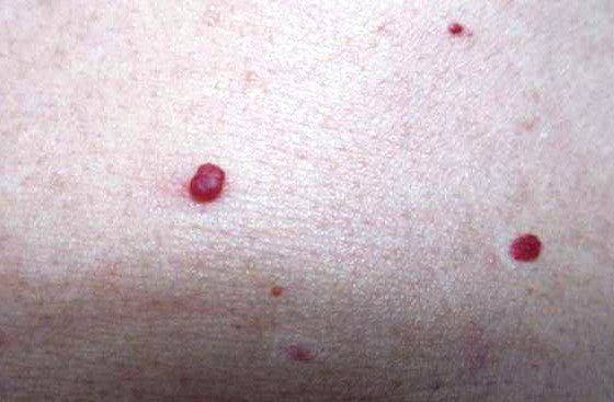 Có "chấm đỏ" này trên da có thể gan đã hỏng nặng-2