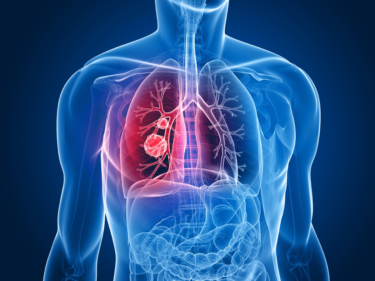 Các triệu chứng của ung thư di căn phổi-1