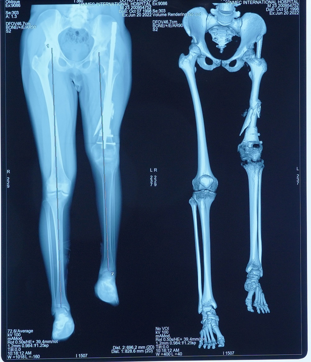 Lần đầu tiên tại Việt Nam, kéo dài chân 13cm cho bệnh nhân ung thư xương-3
